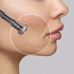Microdermabrasion-Schulung – BKS Beauty & Akademie