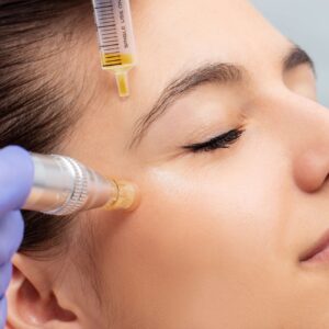 Microneedling Schulung – BKS Beauty & Akademie